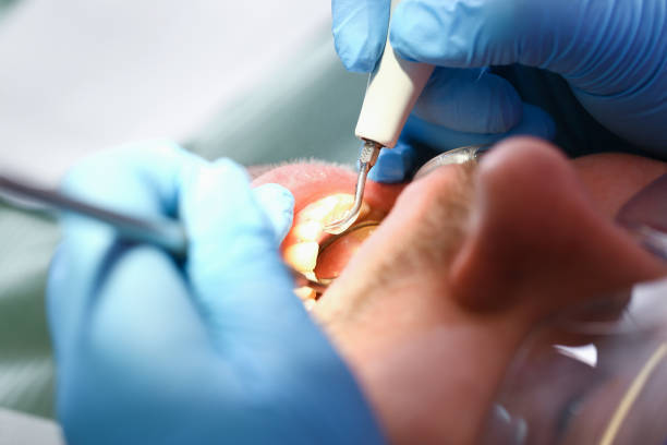 Best Broken or Chipped Tooth Repair in Alderson, WV